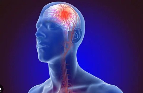 Poor Diet Fueling Stroke Risk – Doctor Poor Diet Fueling Stroke Risk – Doctor